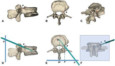 A modified trajectory of kyphoplasty via superior pedicle notch for osteoporotic vertebral compression fractures: Technique note and clinical result